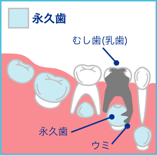 乳歯のむし歯が重症で、根の先に病巣がある場合、直下の永久歯の歯質に影響することがあります。