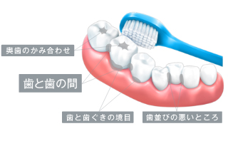 （図3）歯垢が残りやすいところ