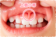 上の前歯2本の間には「上唇小帯」という筋があります。