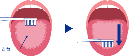 ハブラシを使った舌の清掃方法