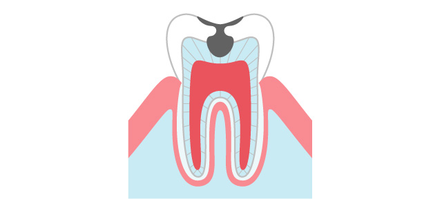 C2（象牙質まで進んだむし歯）