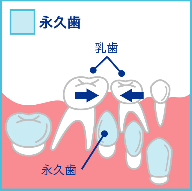 乳歯を早期に失うと、隣り合った歯の移動が起こり、永久歯が生えるスペースがなくなることがあります。