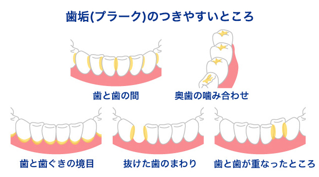 プラークのつきやすいところ 歯と歯の間 奥歯の噛み合わせ 歯と歯肉の境目 抜けた歯のまわり 歯と歯が重なったところ