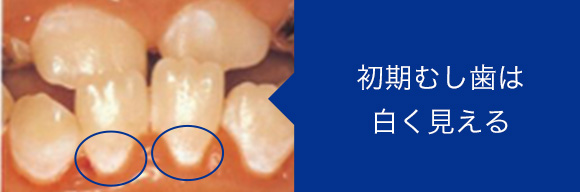 初期虫歯の写真