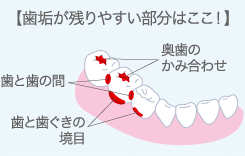 歯垢(プラーク)が残りやすい部分はここ!