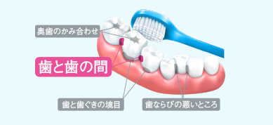 歯垢は歯と歯の間が残りやすい
